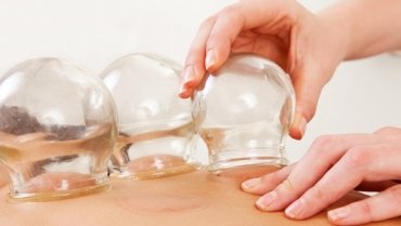 Cupping