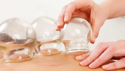Cupping
