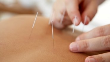 Acupuncture